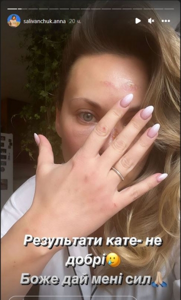 Струс мозку та зламаний нос: Ганна Саліванчук шокувала результатом невдалого падіння (фото)